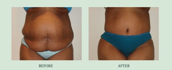 Tucking Your Tummy In Chicago