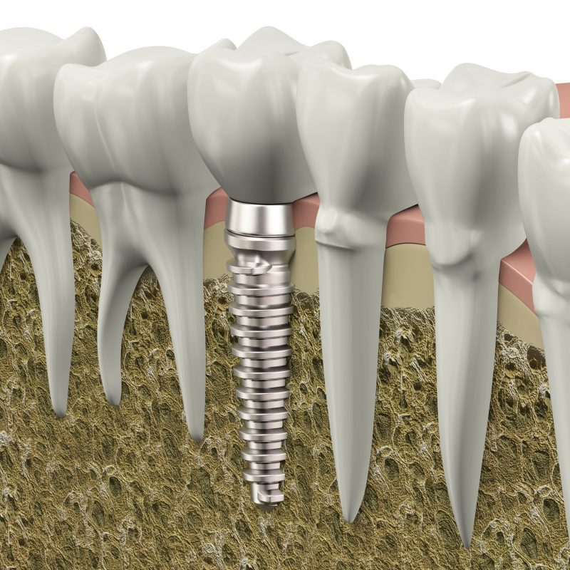 Are You Looking for Affordable Dental Implant Dentures in Panama City, FL?