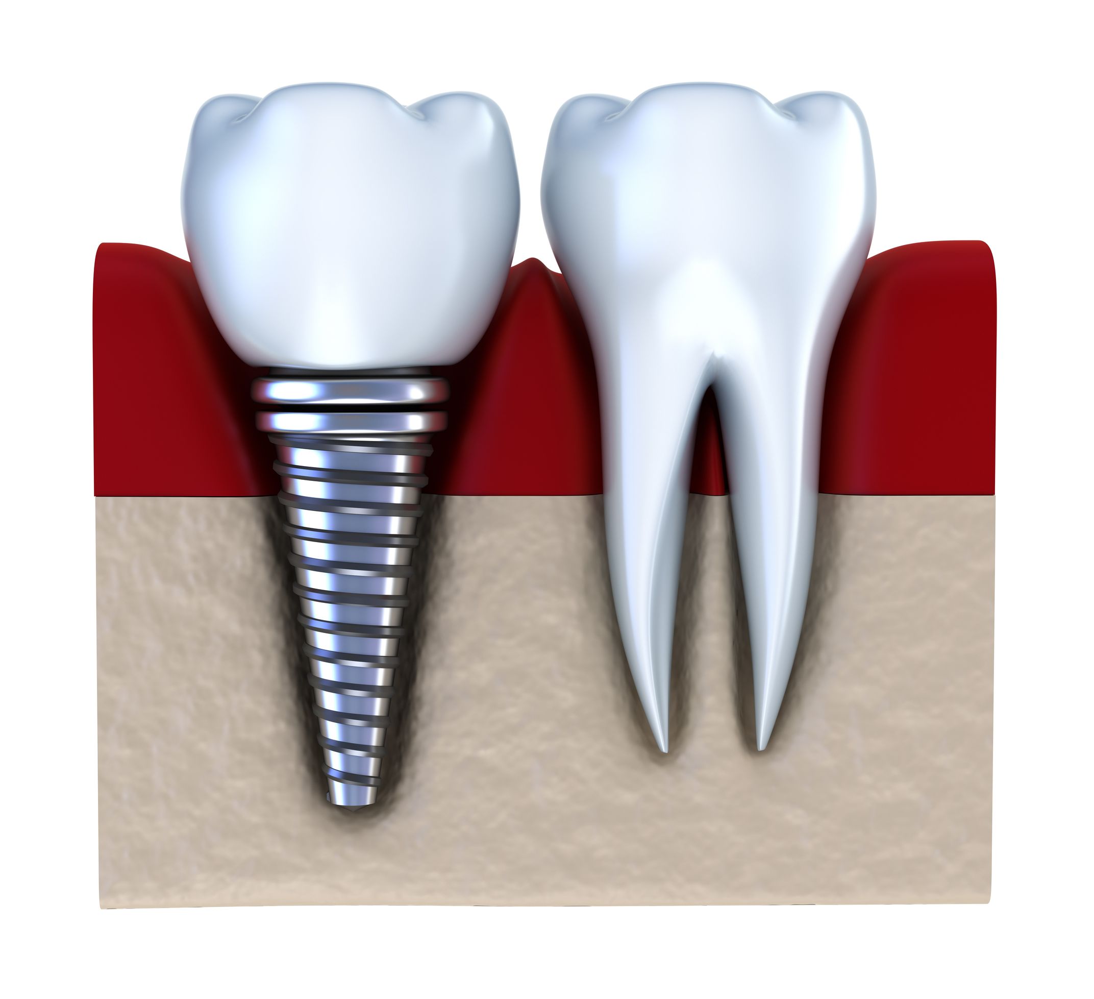 Three Exciting Benefits Of Tooth Implant Services In Camas, WA