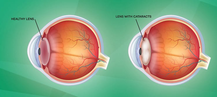 When to See a Cataract Doctor