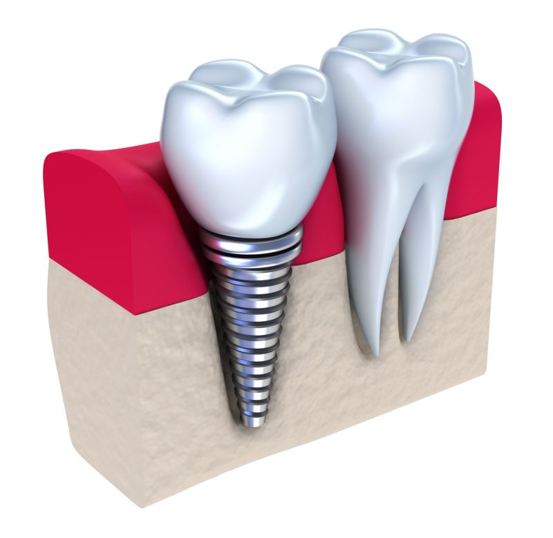 5 Benefits of Dental Implants