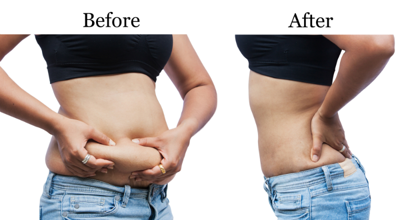 Why Liposuction May Be a Good Option for Eliminating Body Fat