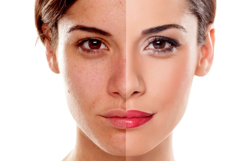 How Does Melasma Laser Treatment Improve the Appearance of the Skin?