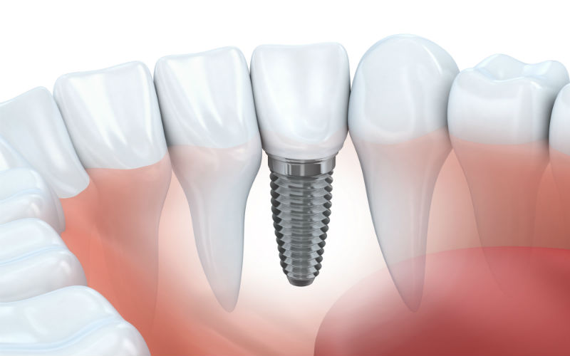 What You Need to Know About Getting a Root Canal in Welland, ON