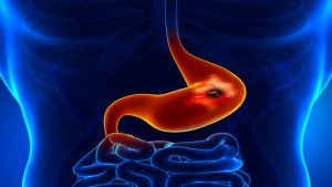 Bariatric Surgery El Paso – Why Should You Consider It?