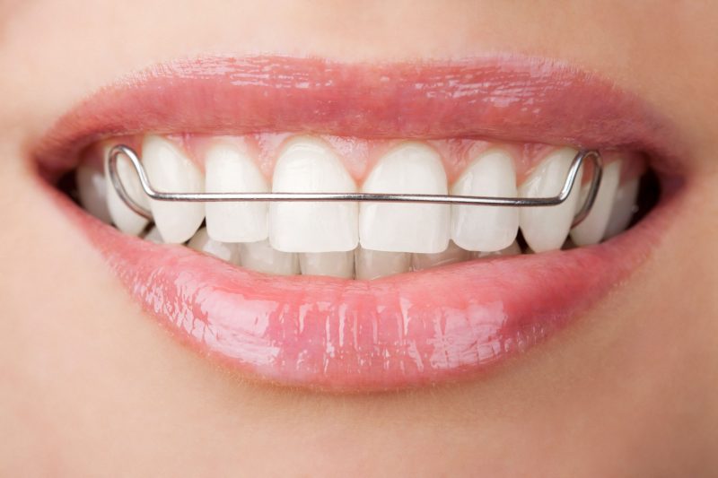 A Brief Guide To Dental Implants In Palm Coast