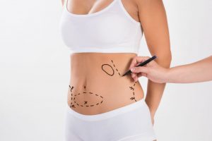 Improve the Contour of Your Body and Your Health With Liposuction