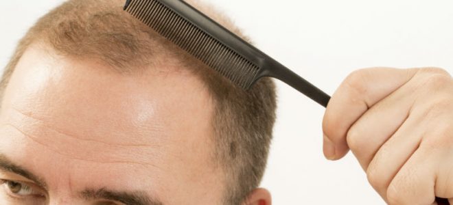 Why New York City Residents Should Consider the FUE Hair Transplant