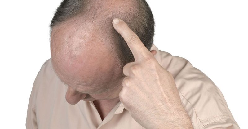 3 Tips for a Successful FUE Hair Transplant in Philadelphia