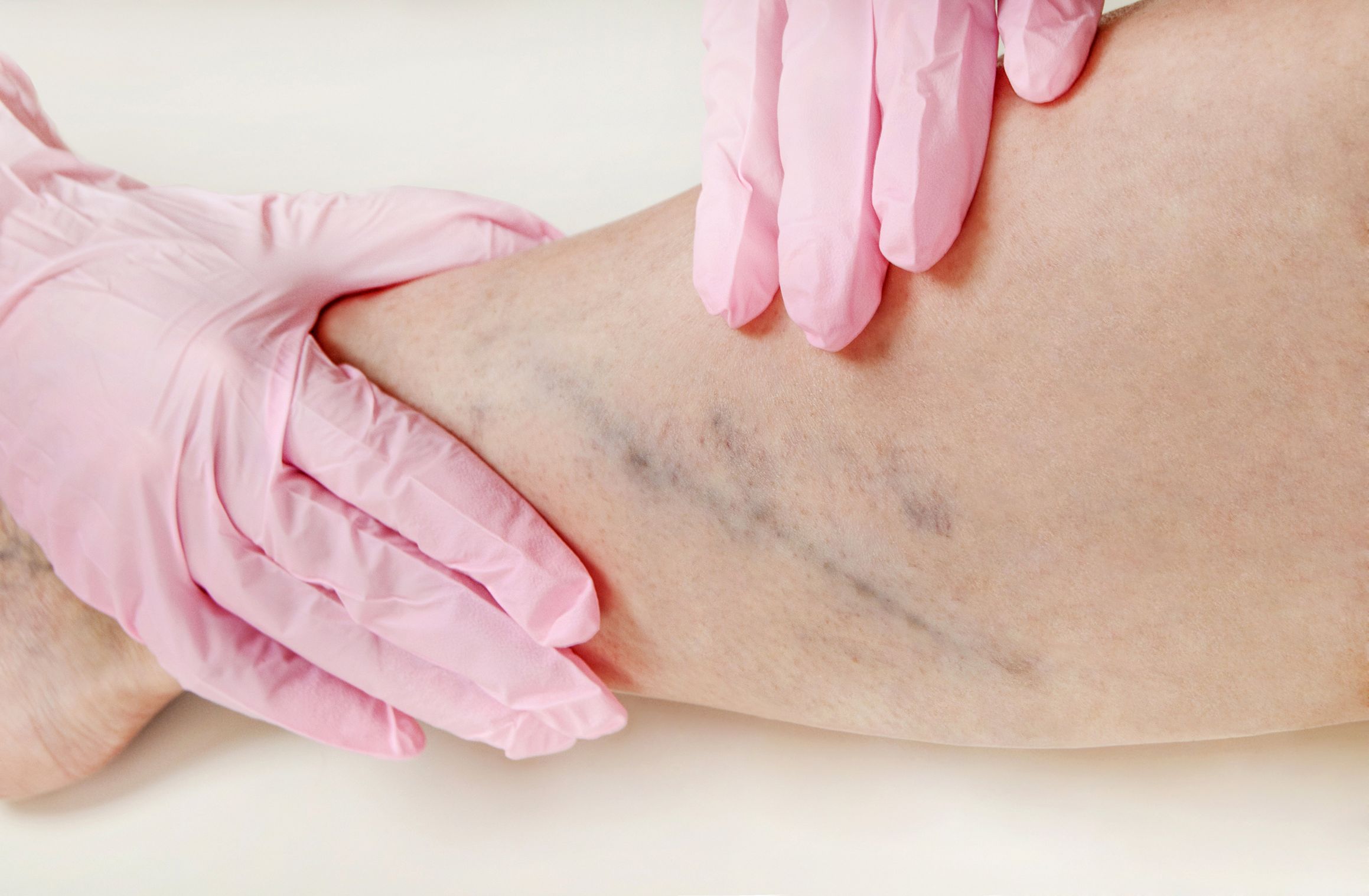 Common Venous Diseases Treated By Vein Doctors in Pennsylvania