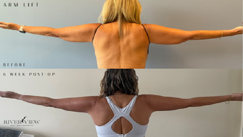 Your Guide to Arm Liposuction in Minneapolis, MN: Sculpting Your Way to Confidence